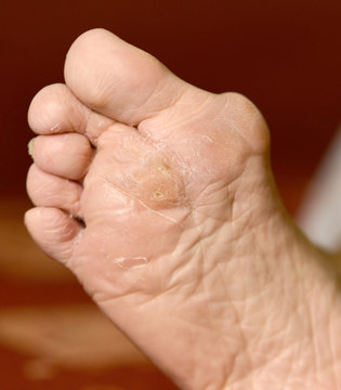 callus