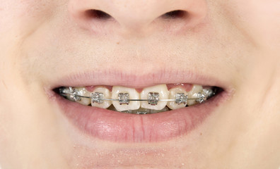 Orthodontics braces
