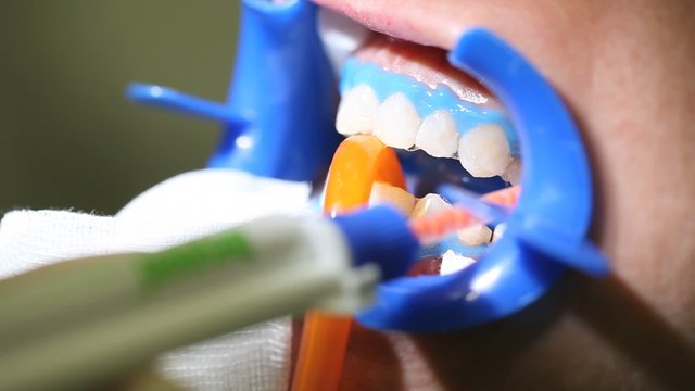 dentist dental cleaning, bleaching