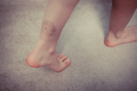 Woman's leg with bruise