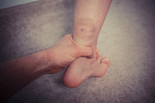 Man grabbing woman's bruised leg