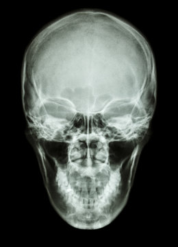 X-ray asian skull (Thai people)