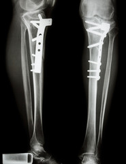 fracture tibia(leg bone). It was operated and internal fixed by