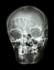 X-ray skull(oblique) of thai people