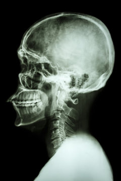 X-ray Asian Skull And Cervical Spine