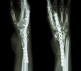 Fracture wrist and chronic infection. It was operated and intern - obrazy, fototapety, plakaty