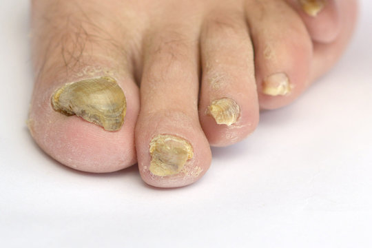 Toenail Fungus