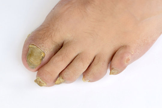 Toenail Fungus