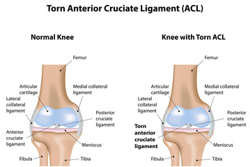 Torn Anterior Cruciate Ligament Knee Joint