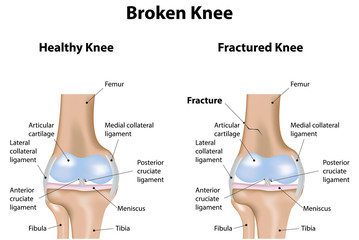 Broken Knee Labeled Diagram