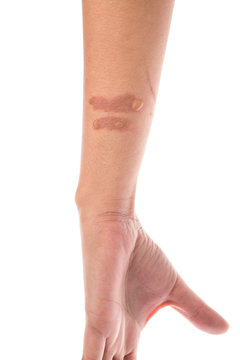 Second degree scald burn blister on forearm