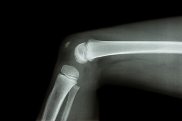 film x-ray knee lateral of child