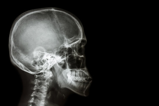 X-ray asian skull (Thai people) and blank area at right side