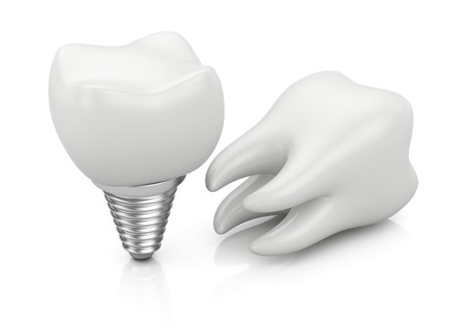 Tooth and dental implant