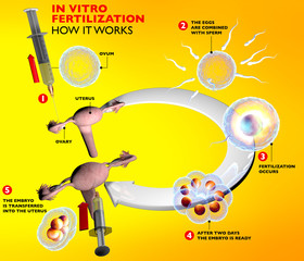 Fecondazione in vitro, percorso inseminazione artificiale