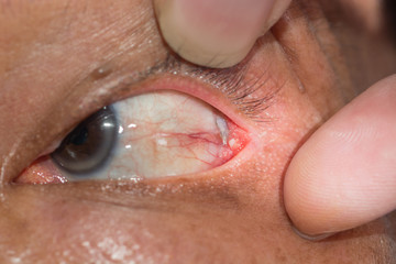 Naklejka premium dermoid cyst