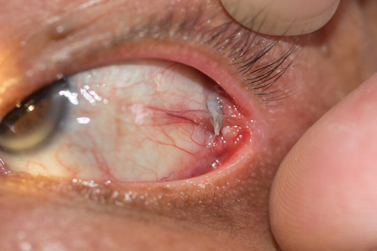dermoid cyst