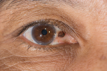pterygium
