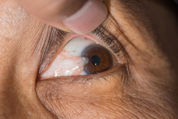 pterygium