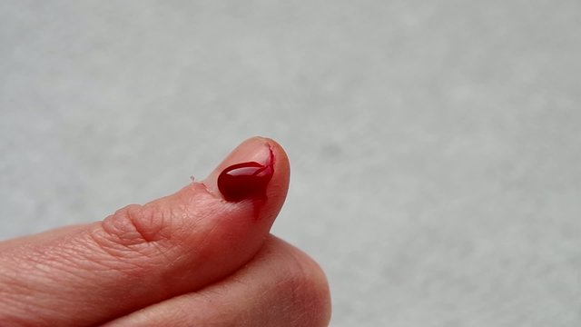 The cut thumb on the hand, and blood