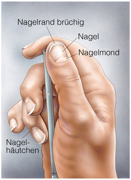 Nagelaufbau.Br&uuml;chige N&auml;gel