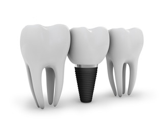 tooth implant