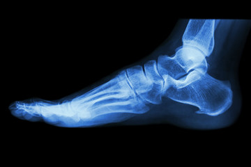 X-ray normal human's foot lateral