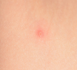 Fototapeta premium acnes sur l'enfant. varicelle