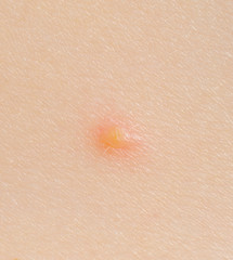 Fototapeta premium chickenpox