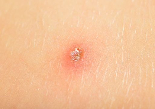 varicelle