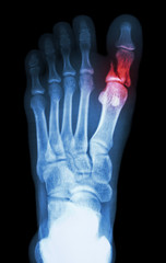 fracture proximal phalange at first toe