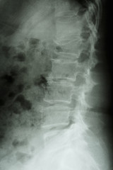 Film x-ray lumbar spine lateral : show burst fracture at lumbar