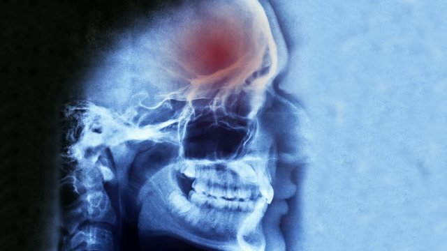headache symptom