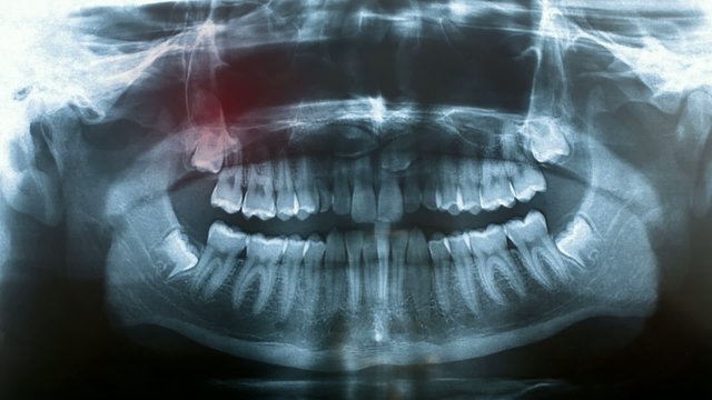 toothache symptom