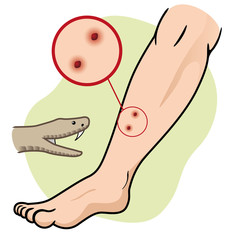 First Aid and snake bite in the leg