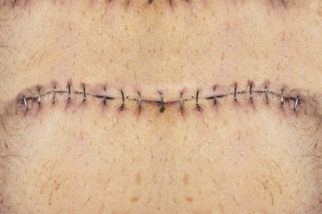 Stitches on belly - obrazy, fototapety, plakaty