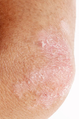 Psoriasis on elbow