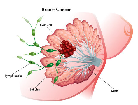 cancro del seno