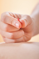 Acupuncturist Placing Needle On Man's Back In Spa