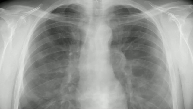 Chest x-ray - smoking.