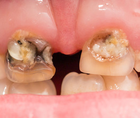 Obraz premium rotten teeth. macro