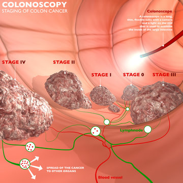 Colonscopia esame colon apparato digerente