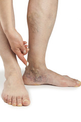 Varicose veins