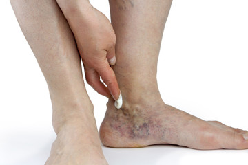 Varicose veins