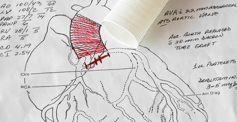 A Cardiac Surgeon's Heart Surgery Diagram