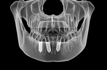 Dental implant and teeth - 65970077