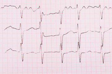 The tape with the cardiogram of a man