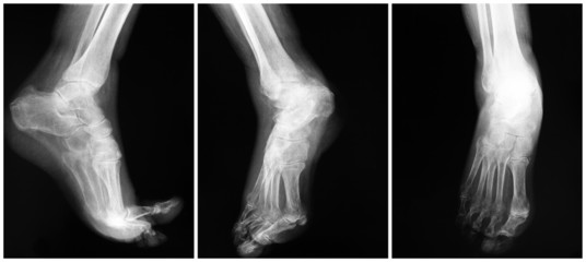 Foot x-ray plates XXL - obrazy, fototapety, plakaty