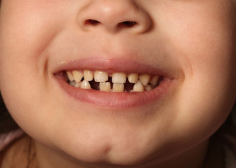  smiling child with baby teeth dropped out. Dental girls bite 