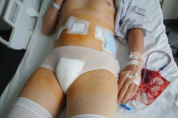 bauchoperation bauchoperation